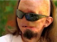 Медики полностью пересадили лицо 25-летнему американцу