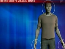 Впервые хирурги одновременно пересадили обе руки и все лицо