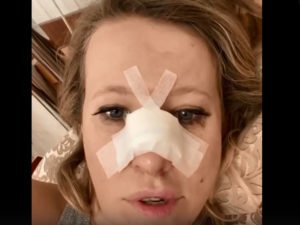 Ксения Собчак со сломанным носом