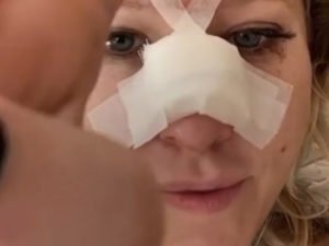 Собчак сломала нос