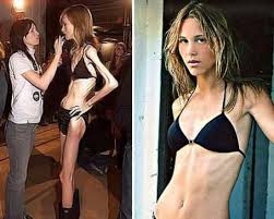 10 знаменитых девушек, которым худоба стоила жизни