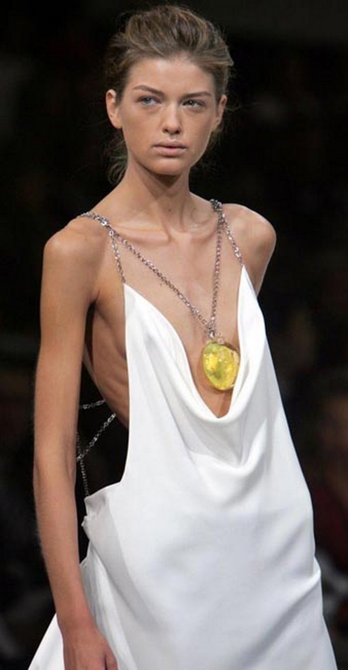 10 знаменитых девушек, которым худоба стоила жизни