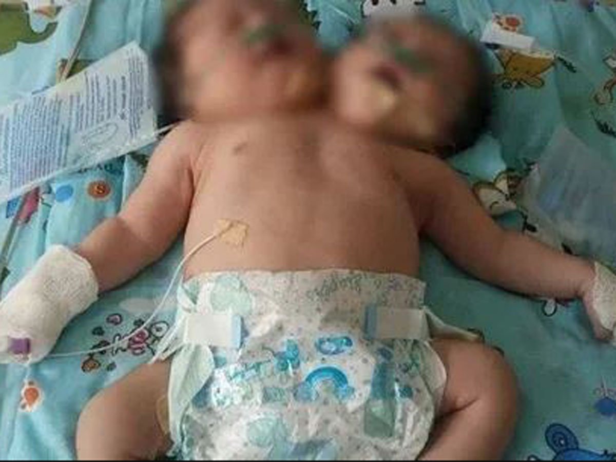 От двухголового младенца, рожденного в Узбекистане, отказались родители