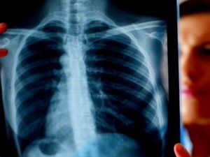 Онколог объяснил. что увеличивает угрозу рака