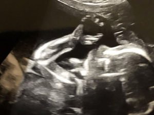 Ребенок в утробе показал неприличный жест
