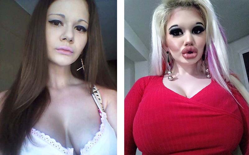 Девушка напугала подписчиков, увеличив губы «в 21-й раз»