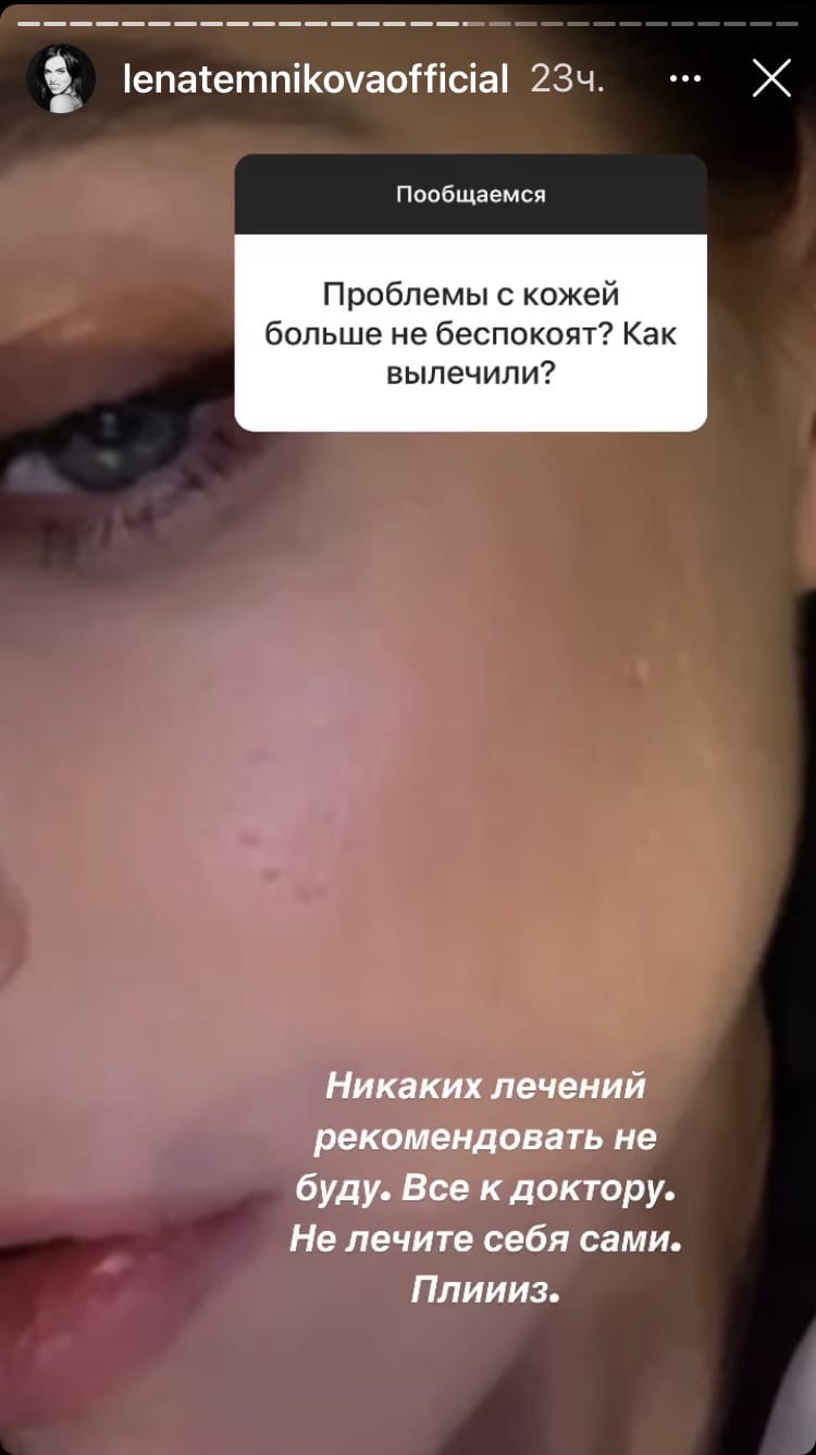Елена Темникова показала лицо со следами от огромных прыщей