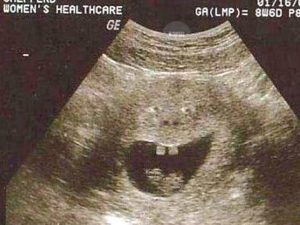 Беременная женщина увидела на УЗИ «Медового монстра»