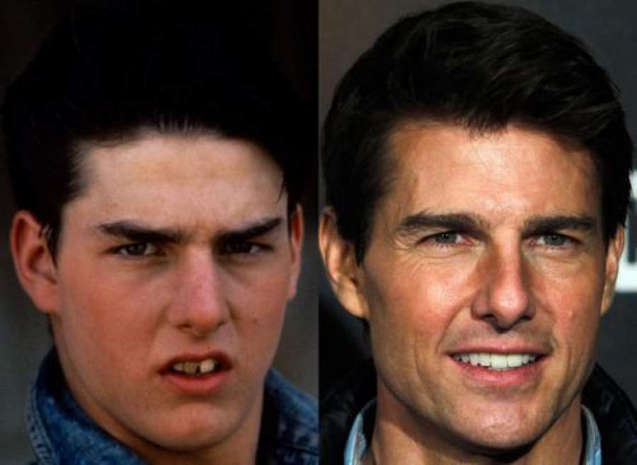 Звезды, внешность которых изменила коррекция зубов