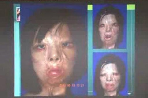 Самые первые и невероятные пересадки человеческих органов