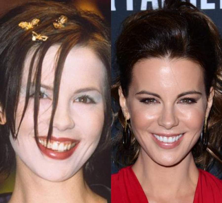 Звезды, внешность которых изменила коррекция зубов