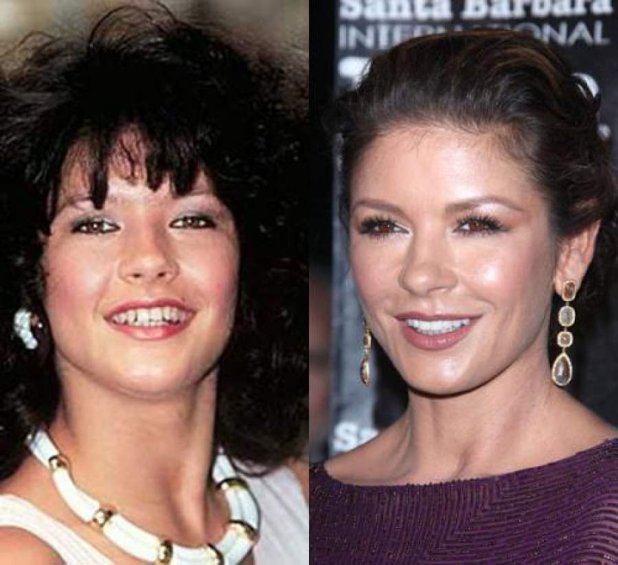 Звезды, внешность которых изменила коррекция зубов