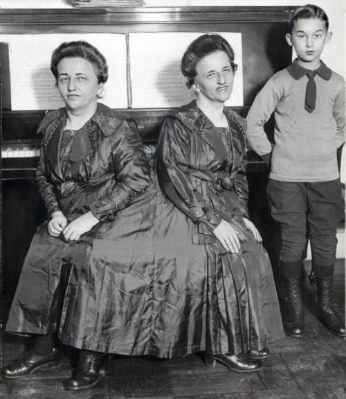 Самые известные истории сиамских близнецов