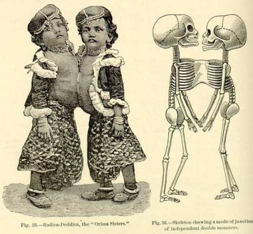 Самые известные истории сиамских близнецов