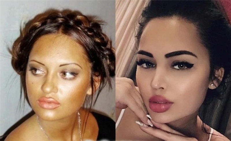 Как выглядели российские звезды до пластики: редкие фото