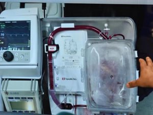 пересадка человеку свиное сердце