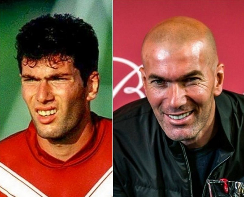 Как выглядели лысые знаменитости до того, как потеряли волосы