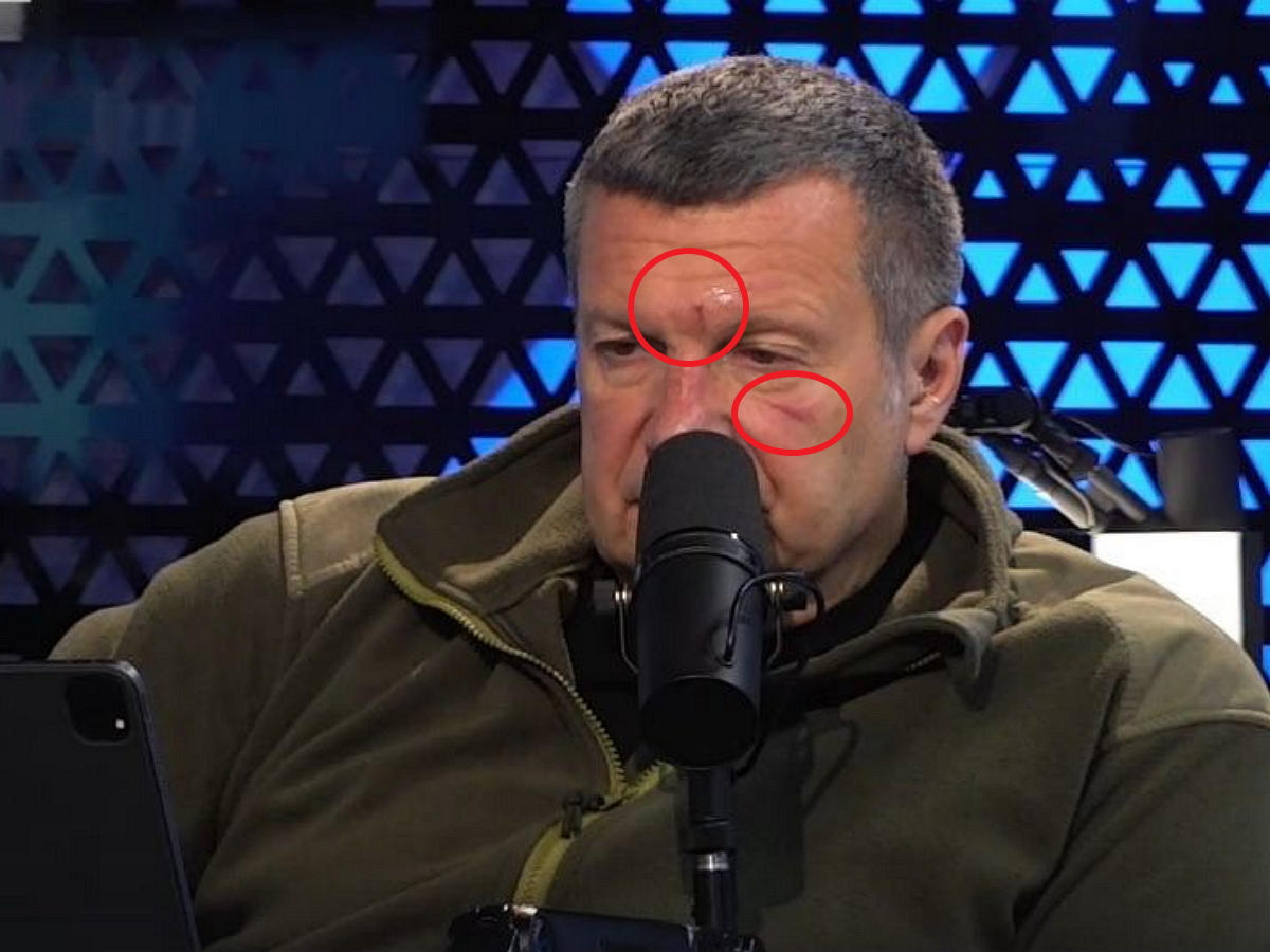 Телеведущий Соловьев отказался объяснять появление синяка под глазом
