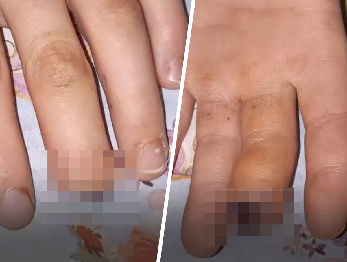 Под Иркутском школьники оторвали палец однокласснику и затоптали его