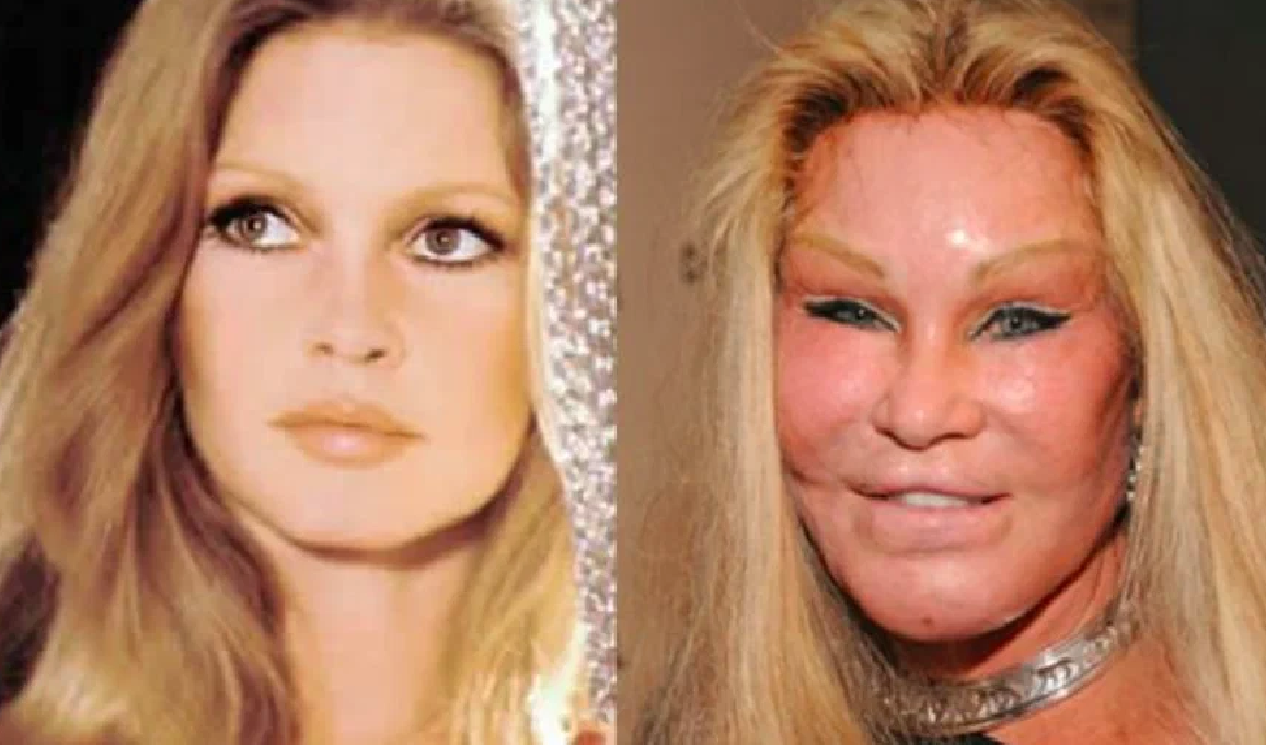 Звезды до и после пластики: найдите отличия