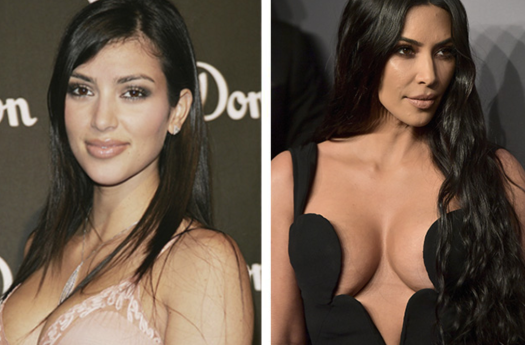 Звезды до и после пластики: найдите отличия