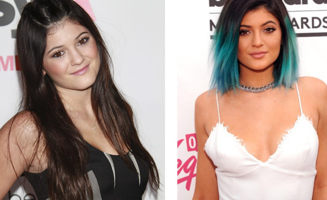 Звезды до и после пластики: найдите отличия