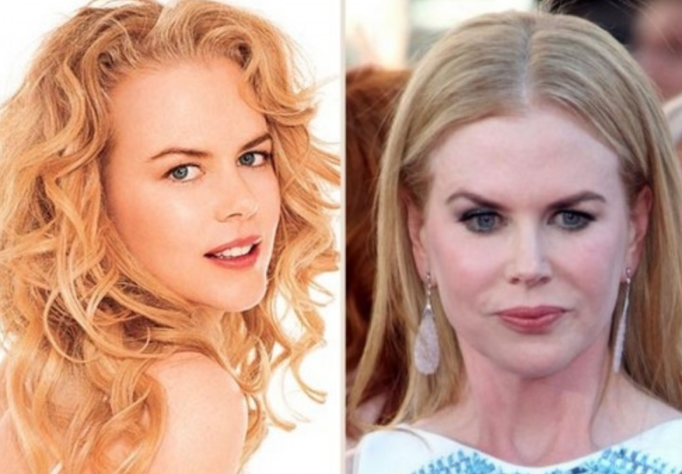 Звезды до и после пластики: найдите отличия