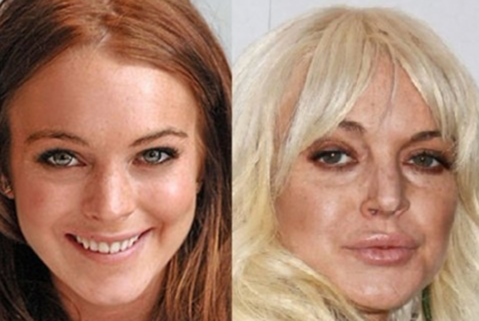 Звезды до и после пластики: найдите отличия