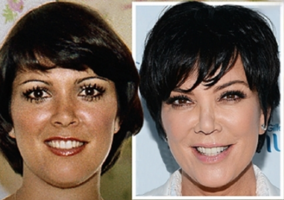 Звезды до и после пластики: найдите отличия