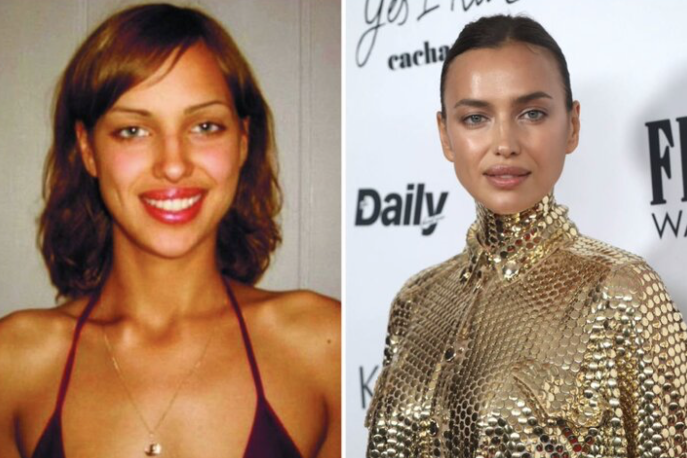 Звезды до и после пластики: найдите отличия