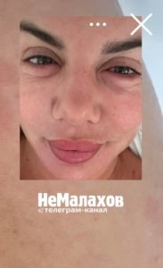 “Превратилась в Шрека”: Анна Седокова показала обезображенное болезнью лицо (ФОТО)