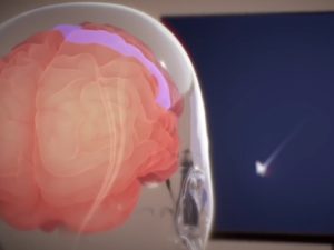 Илон Маск раскрыл, как живет пациент с нейрочипом Neuralink в мозге