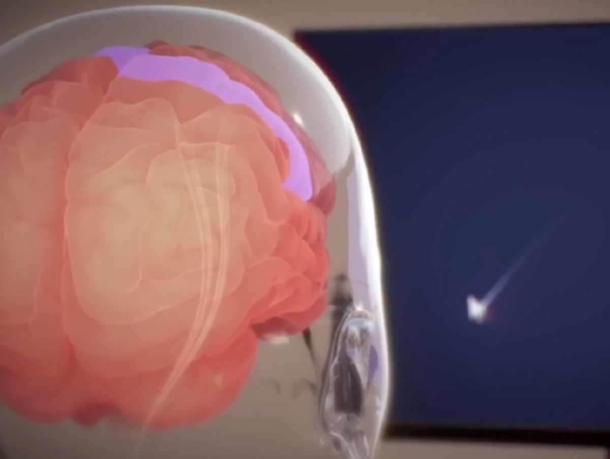 Илон Маск раскрыл, как живет пациент с нейрочипом Neuralink в мозге