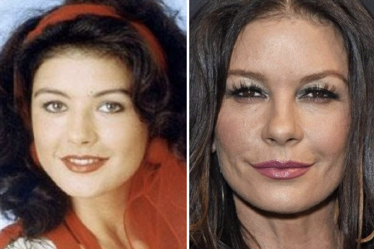 Звезды, у которых пухлые щечки превратились в красивые скулы