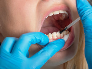 СМИ: россияне массово скупают наборы для самостоятельного пломбирования зубов