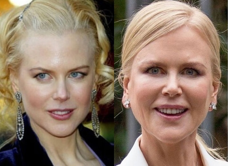 24 случая, когда бьюти-процедуры улучшили или испортили знаменитостей