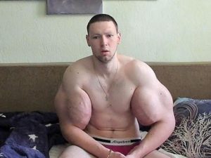 У блогера Руки-Базуки начала гнить рука: фото ужаснули россиян