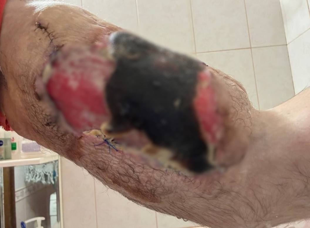 У скандального блогера Руки-Базуки начала гнить рука: фото ужаснули россиян