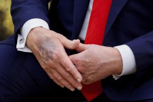 Трамп с синяком на руке