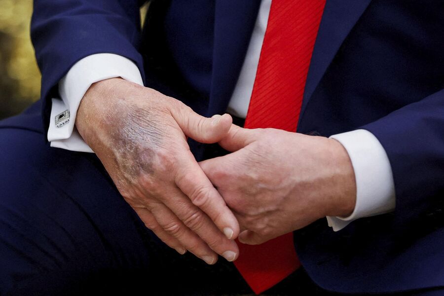 Трамп объяснил, откуда у него появляются чудовищные синяки на руках