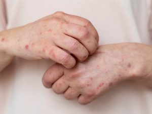 В Подмосковье госпитализированы мужчины с подозрением на заболевание оспой обезьян